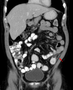 Appendicitis epiploica am C. descendens