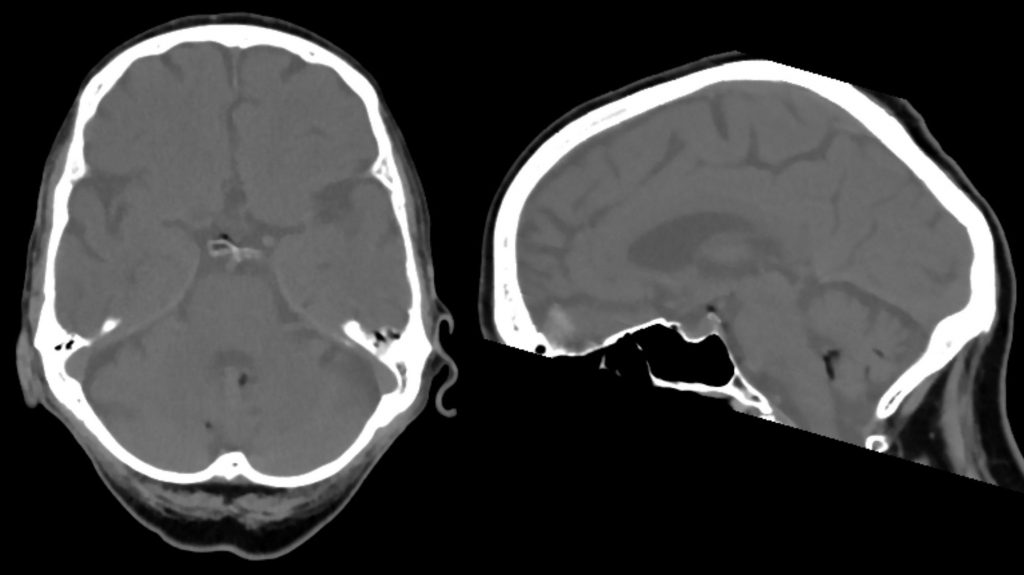 CCT basal axial sagittal