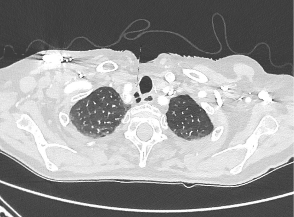 Trachealdivertikel Pfeil